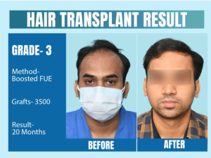 Hair Transplant in Delhi: Essential Post-Surgery Care and Precautions for Optimal Healing